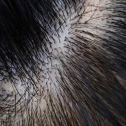 ScalpGod SMP & Hair Restoration - Female client Pre-Density Treatment