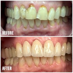 4 porcelain crowns