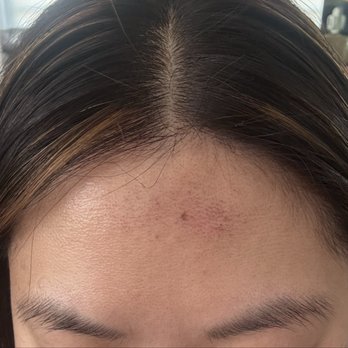QT Salon - Forehead chemical burn. - Hair Salons Near Me - Westminster, California QT Salon - Forehead chemical burn. - Hair Salons Near Me - Westminster, California