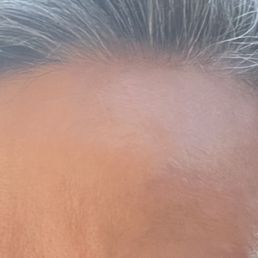 After: This is my forehead now, with no makeup or filters. The scar blends in and is unnoticeable. After: This is my forehead now, with no makeup or filters. The scar blends in and is unnoticeable.