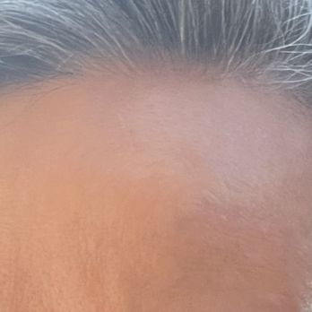 Fancy Shmancy - After: This is my forehead now, with no makeup or filters. The scar blends in and is unnoticeable. - Permanent Makeup Near Me - Highland Park, Illinois