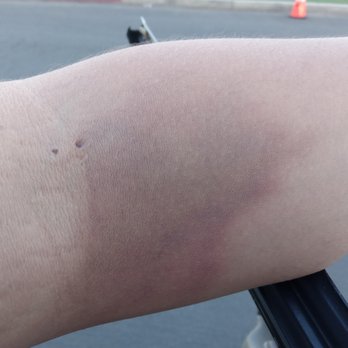 Grifols - Bruised and abused by Biomat (Reseda) - Blood & Plasma Donation Centers Near Me - Reseda, California Grifols - Bruised and abused by Biomat (Reseda) - Blood & Plasma Donation Centers Near Me - Reseda, California