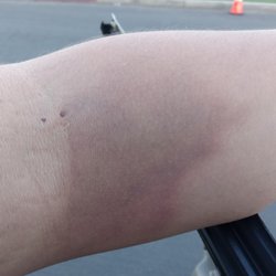 Grifols - Bruised and abused by Biomat (Reseda)