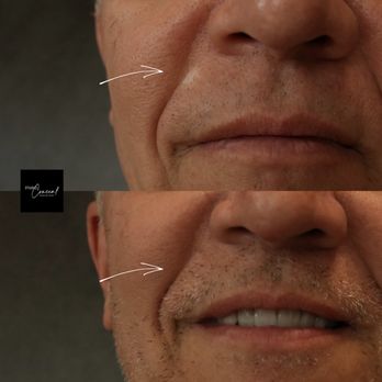 Medical Body Blending - before and after of our skin color ink to seemlessly blending the scar into the skin - Tattoo Near Me - Austin, Texas Medical Body Blending - before and after of our skin color ink to seemlessly blending the scar into the skin - Tattoo Near Me - Austin, Texas