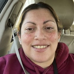 Sunny Smile Dental - After the teeth got fixed from  two cavities