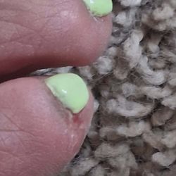 3D Nails - Where she cut me again, very painful this morning.