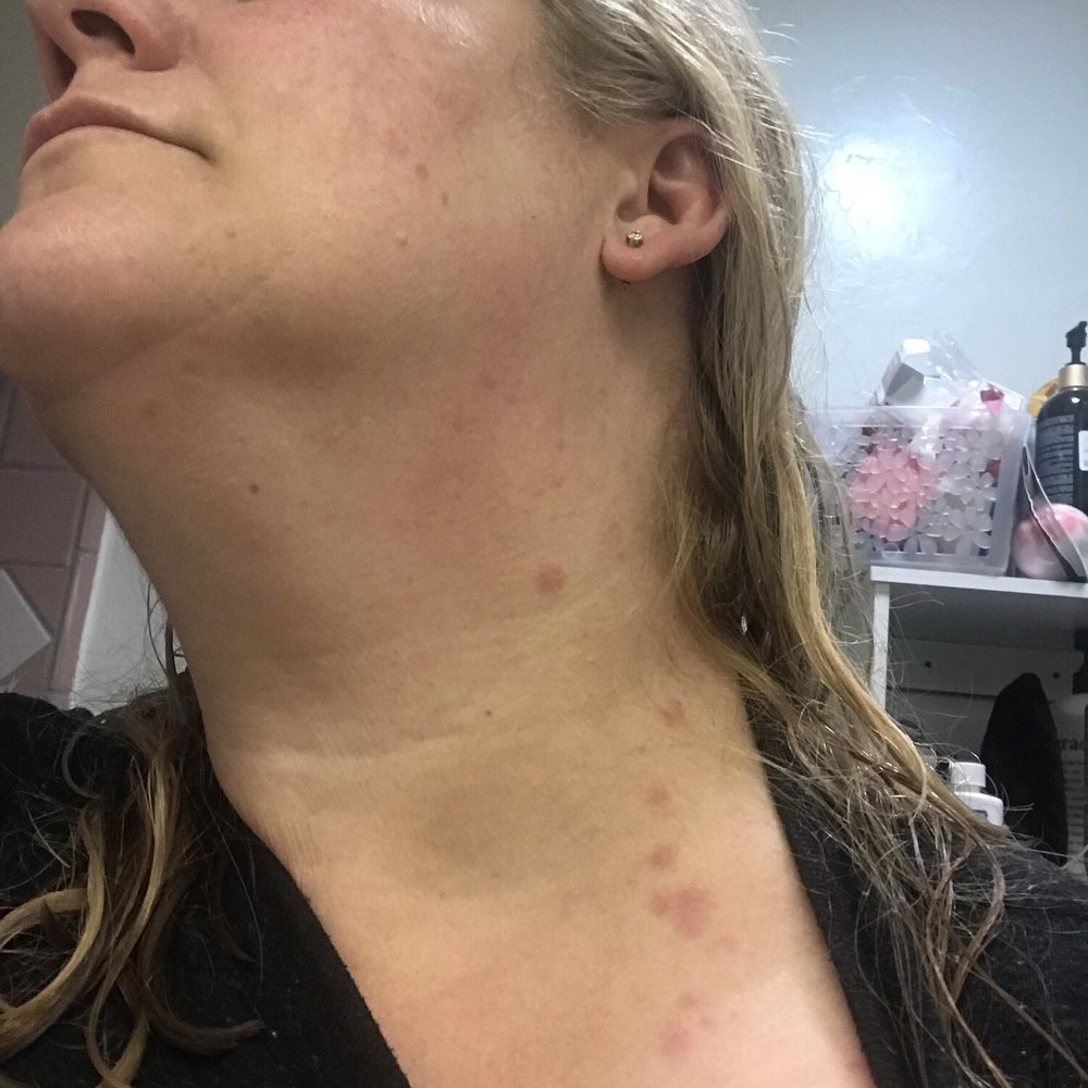 Miami Airport Hotel - Bed bug bites - Hotels Near Me - Miami, Florida Miami Airport Hotel - Bed bug bites - Hotels Near Me - Miami, Florida