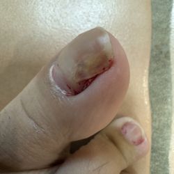 Fox Valley Foot & Ankle Specialists - There is still a giant ugly crack after 2 month of the surgery, and this should not happen