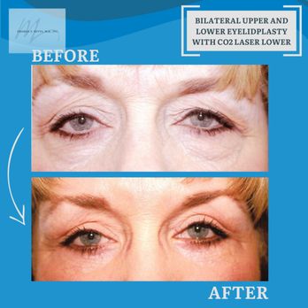 Thomas F. Mitts, MD - Before & After from Thomas F. Mitts, MD, Inc. | Visalia, CA - Cosmetic Surgeons Near Me - Visalia, California Thomas F. Mitts, MD - Before & After from Thomas F. Mitts, MD, Inc. | Visalia, CA - Cosmetic Surgeons Near Me - Visalia, California
