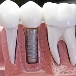 Dental Avenue - Dental Implants