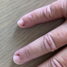 Blood from cuticle trimming Blood from cuticle trimming