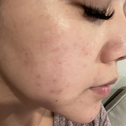 Susie Q Skincare - After 3 month of getting facial, my break out is under control