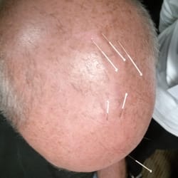 Essence of Acupuncture