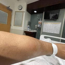 Community Hospital North - Swelling w/iv fluid