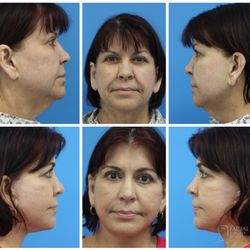 Marcelo Hochman, MD - The Facial Surgery Center - Deep Plane Facelift + Endoscopic Browlift