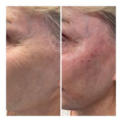 Artem Med Spa - Revive your youth with cheek and temporal dermal fillers!