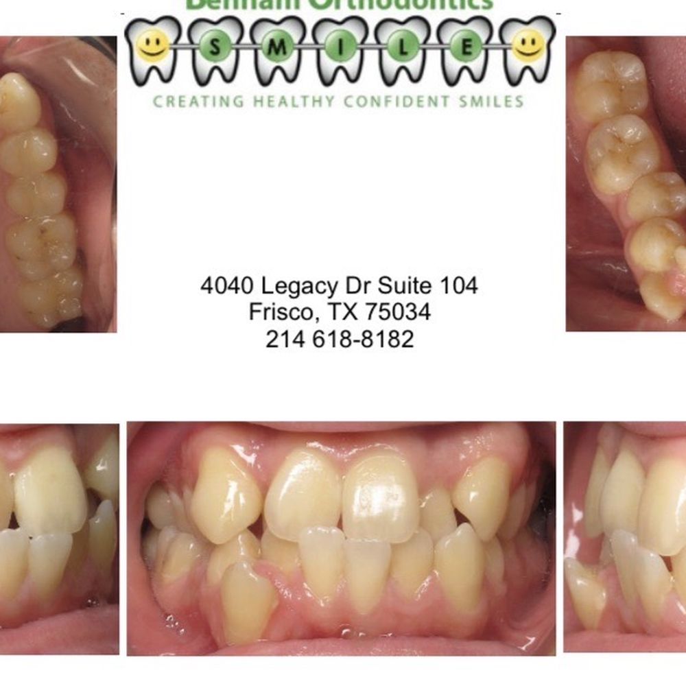 Benham Orthodontics - Initial consultation photos - Orthodontists Near Me - McKinney, Texas Benham Orthodontics - Initial consultation photos - Orthodontists Near Me - McKinney, Texas