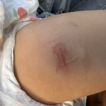 Coastal Kids - A big scratch after the vaccine. - Pediatricians Near Me - Irvine, California