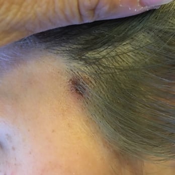 Zolf Salon - These are just some of the spots of burn on my head I have tons - Hair Stylists Near Me - San Ramon, California