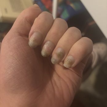 VIP Nail Bar - Serious bruising and damage - Nail Salons Near Me - Okemos, Michigan VIP Nail Bar - Serious bruising and damage - Nail Salons Near Me - Okemos, Michigan
