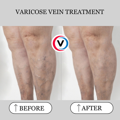 Varicose Vein - Using ultrasound-guided radiofrequency ablation (RFA), we close off diseased veins with minimal discomfort. The procedure is performed entirely in-office, takes about an hour, and patients walk out the same day. No general anesthesia, no hospital stay, no lengthy recovery. Varicose Vein - Using ultrasound-guided radiofrequency ablation (RFA), we close off diseased veins with minimal discomfort. The procedure is performed entirely in-office, takes about an hour, and patients walk out the same day. No general anesthesia, no hospital stay, no lengthy recovery.