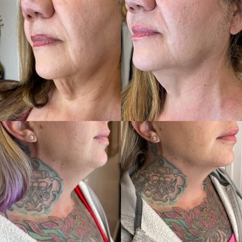 Fibroplasmabeauty - Neck lift - Permanent Makeup Near Me - Pleasant hill , California