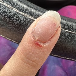 The red clot at the end of of the nail is blood from the nerve under my nail from the overfilling and burning from the electric filer