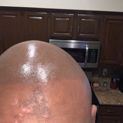 David Creech, MD - The scars that were left over from the botched procedure.