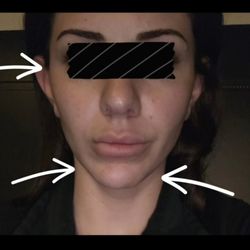 Rejuv Medspa - The protrusion on the bottom left of my jaw and the height difference in my right cheek, which affect my overall appearance.