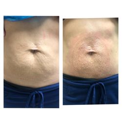 Vitality Health & Wellness - Skin tightening using plasma pen fibroblasting!
