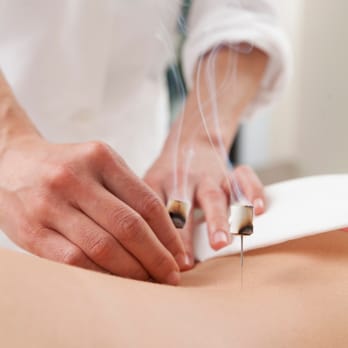 Melida Acupuncture - Moxibustion helps to strengthen the blood, stimulate the flow of qi, and maintain general health. - Acupuncture Near Me - San Diego, California Melida Acupuncture - Moxibustion helps to strengthen the blood, stimulate the flow of qi, and maintain general health. - Acupuncture Near Me - San Diego, California