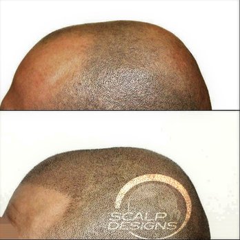 Scalp Designs - Before & After of Scalp Designs client - Hair Loss Centers Near Me - Milton, Massachusetts Scalp Designs - Before & After of Scalp Designs client - Hair Loss Centers Near Me - Milton, Massachusetts