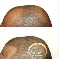 Scalp Designs - Before & After of Scalp Designs client