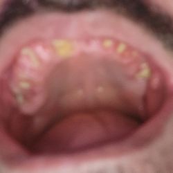 Walgreens - This is a picture of my mouth I don't have $60,000 for Florida to get it fixed So my mind is really hazy from the pain all the time