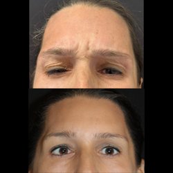 Zuliani Facial Aesthetics - Dysport