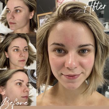 Elegant Esthetics - Dermaplane Facial - Skin Care Near Me - Huntington Beach, California Elegant Esthetics - Dermaplane Facial - Skin Care Near Me - Huntington Beach, California