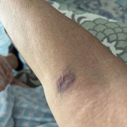 Labcorp - Blew this vein but did get the blood she needed.