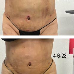 Post Op Curves - 1 weekwith 3 sessions
