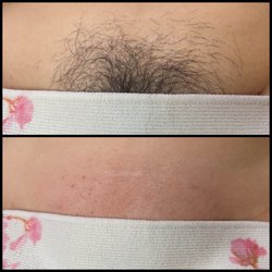 Brazilian wax