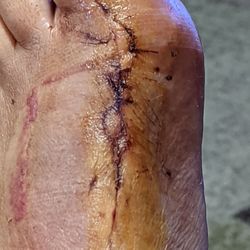 Foot & Ankle Clinics Of Arizona - Burns from ignoring my allergies to tape bracelet