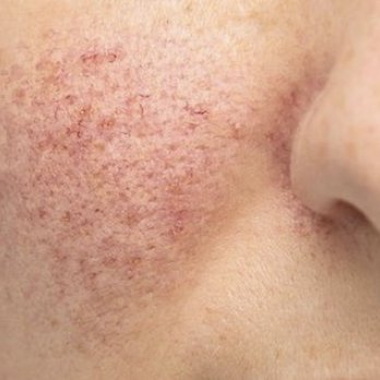 Magnificat Wellness Center - my skin @ worst (may 2019) - Medical Spas Near Me - Spring, Texas Magnificat Wellness Center - my skin @ worst (may 2019) - Medical Spas Near Me - Spring, Texas
