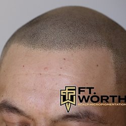 Fort Worth Scalp Micropigmentation