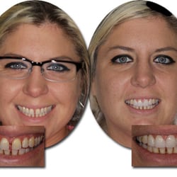 4 EasySmile Veneers to close unwanted spaces, 1 short visit, very affordable!