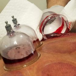 Hijama House of Cleveland