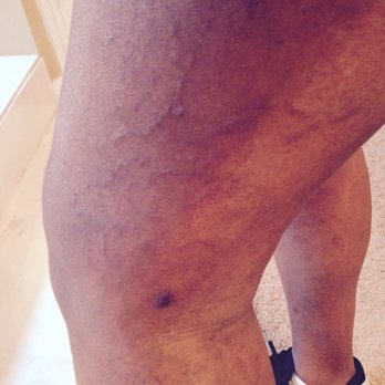 Germantown Aesthetics - Results of Germantown Aesthetics sclerotherapy (mal) treatment. Beware. - Dermatologists Near Me - Germantown, Tennessee Germantown Aesthetics - Results of Germantown Aesthetics sclerotherapy (mal) treatment. Beware. - Dermatologists Near Me - Germantown, Tennessee