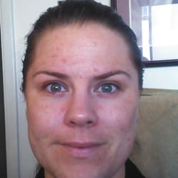 Skin Fx  - First Visit to Celena day 6 (4/12/13)