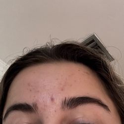 Revive Skin Care Salon - August acne