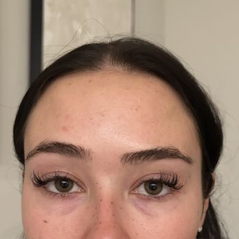 NewSkin Laser Center - Completely uneven. IM NOT MAKING A FACE. THIS IS MY FACE NOW EVEN RELAXED - Medical Spas Near Me - Simi Valley, California NewSkin Laser Center - Completely uneven. IM NOT MAKING A FACE. THIS IS MY FACE NOW EVEN RELAXED - Medical Spas Near Me - Simi Valley, California