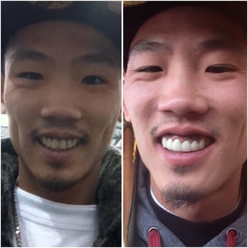 Joseph Lee, DDS - Mountain View Family & Cosmetic Dentistry - Amazing dental transformation done on my husband by Dr. Joseph Lee. His teeth look perfect and he looks like a different person! - Cosmetic Dentists Near Me - Mountain View, California