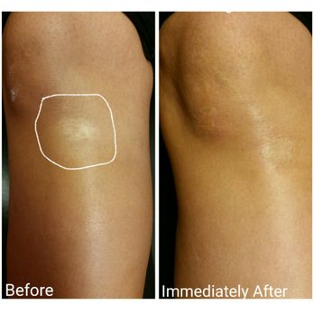 Permanent By Paige - Scar Camouflage- Before & Immediately After - Permanent Makeup Near Me - Gilbert, Arizona